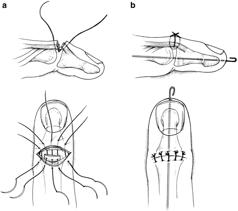 Tendon Repair