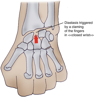 Scaphoid Lunate Ligament Tear