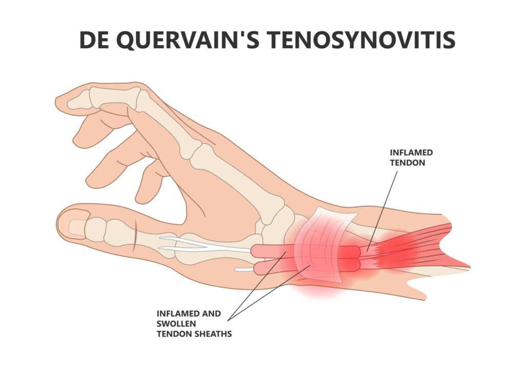 De Quervain's Tenosynovitis