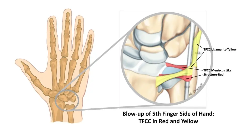 Recovering from TFCC Injury and Rehab requires a clear understanding of the anatomy