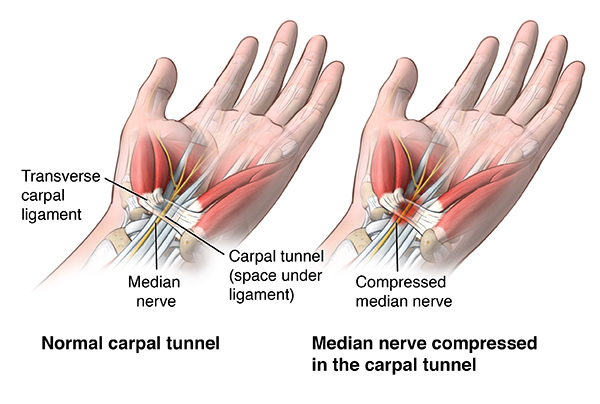 Carpal Tunnel Syndrome Physio