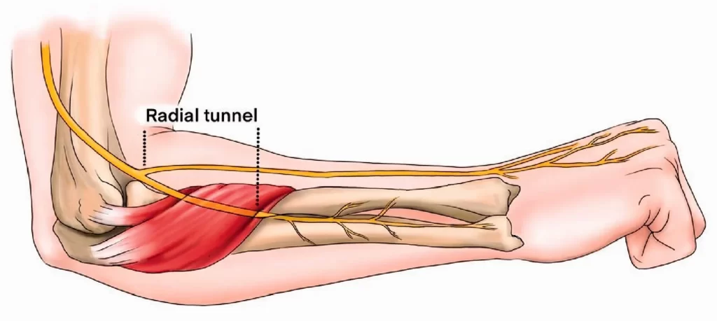 Radial Tunnel Syndrome Treatment Melbourne