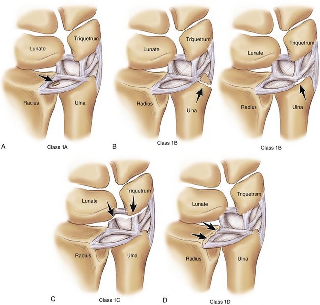  Palmer classification for acute TFCC injuries. Class 1A lesion involves a tear in the central, horizontal portion of the TFCC